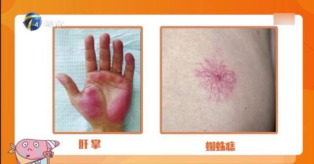 忘记定期体检,肝癌悄悄来临,这些人群要格外注意|肝癌|肝掌|蜘蛛痣