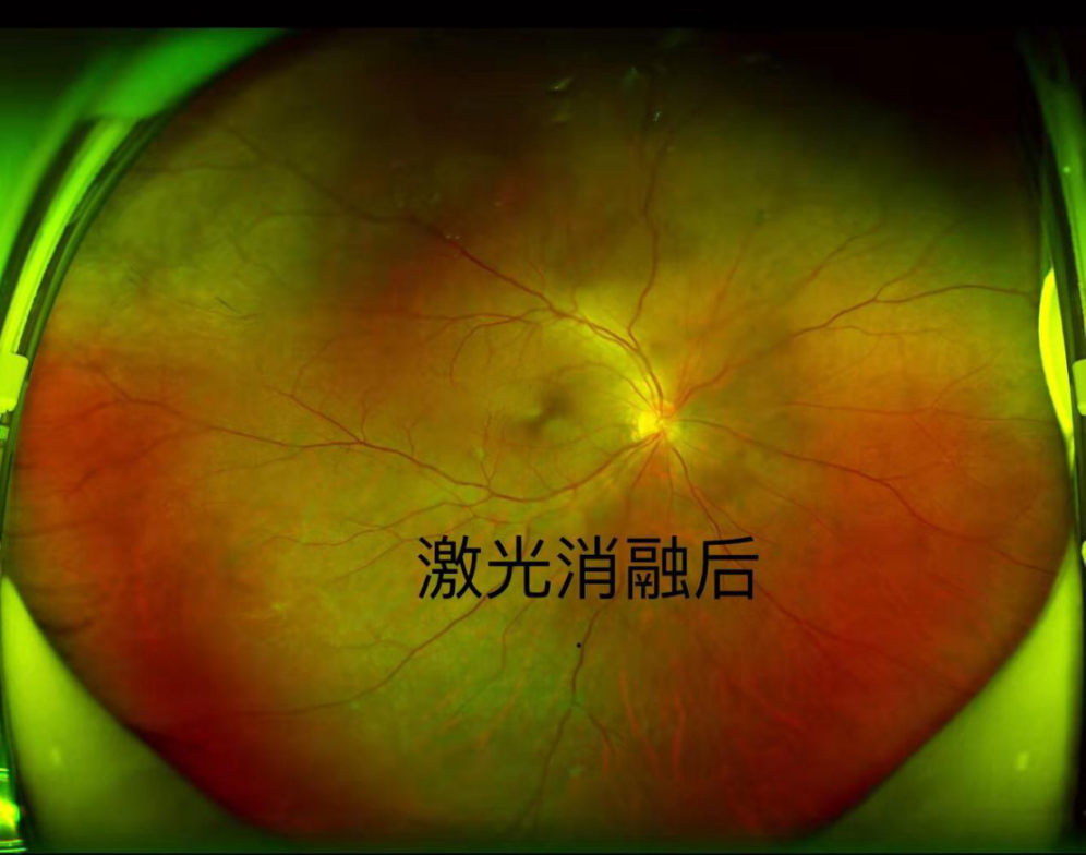 华山眼科飞蚊症门诊已为数百名患者成功驱蚊