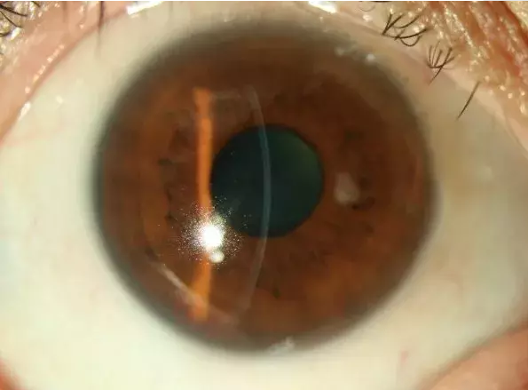 人工造"泡沫雪"有危险,小心雪花喷雾造成角膜损伤