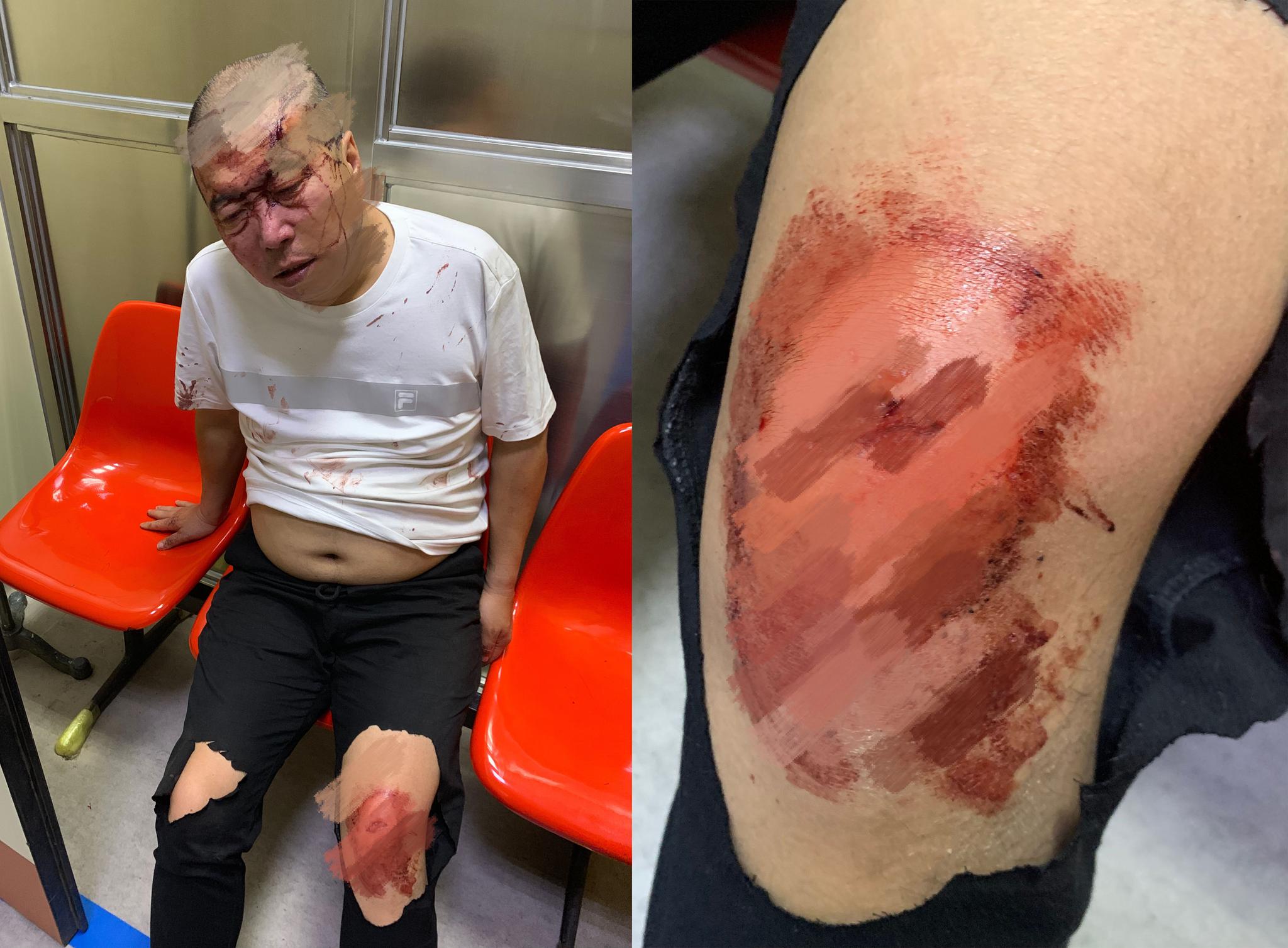 大爷走夜路被陌生男子用棍棒暴打,伤重坐轮椅,至今想不通为什么