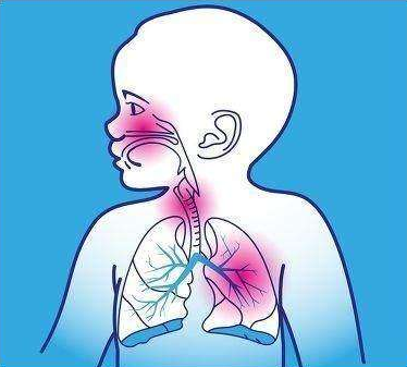 吸入性肺炎症状 新浪网