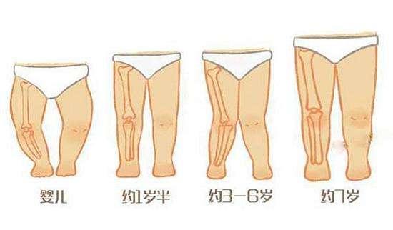 孩子腿型不直会不会有问题?儿童骨科医生教你辨别需不需要治疗