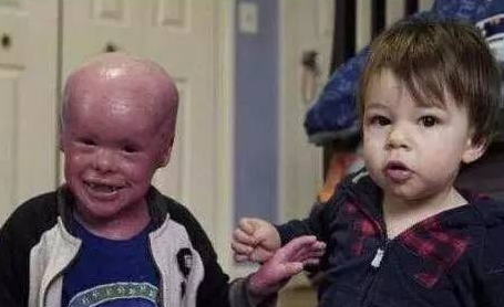 5岁男孩 全身长满 鱼鳞 父母天天为其刮鳞 大开眼界