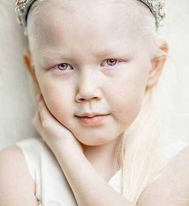 西伯利亚白雪公主,8岁白化症女童成知名模特儿