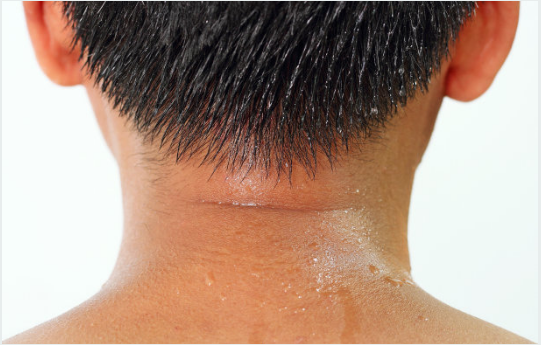 多汗症怎么治疗_太壹清汗汤