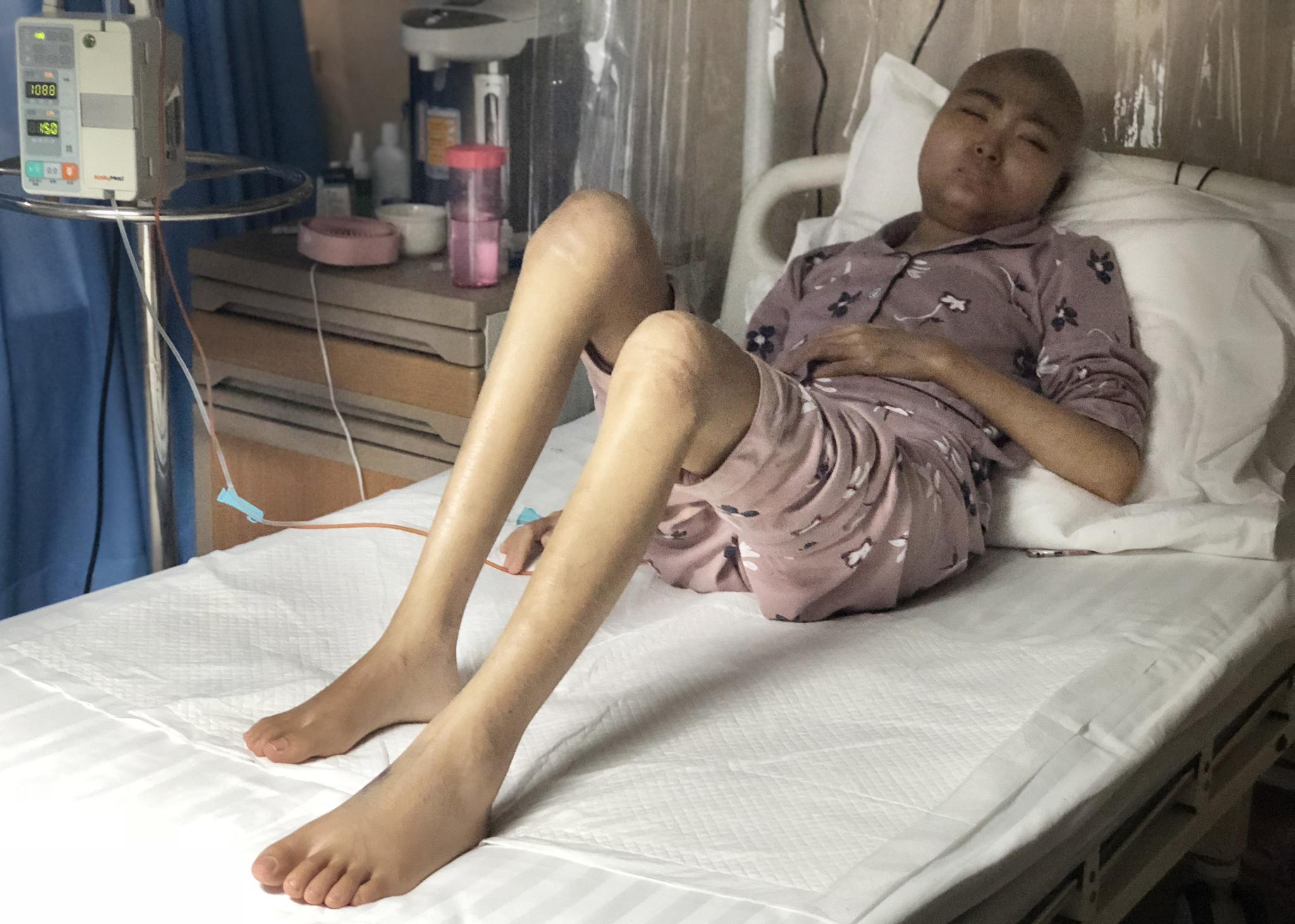 女孩抗白4年花160万3次复发,骨瘦如柴浑身变黑,妈妈崩溃|抗癌|欣欣