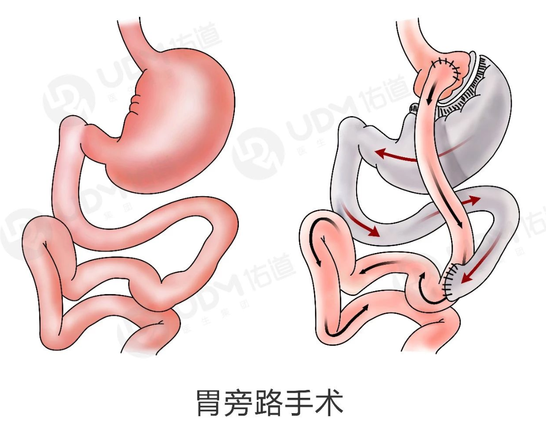 疫情下糖尿病人致死率更高,专家建议糖胖患者可尝试胃旁路手术