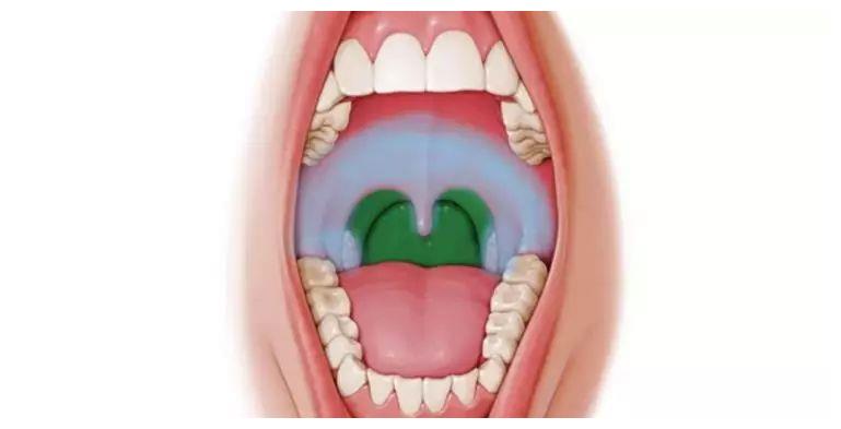 宝宝高热,不吃饭,喉咙痛,别再当感冒治了