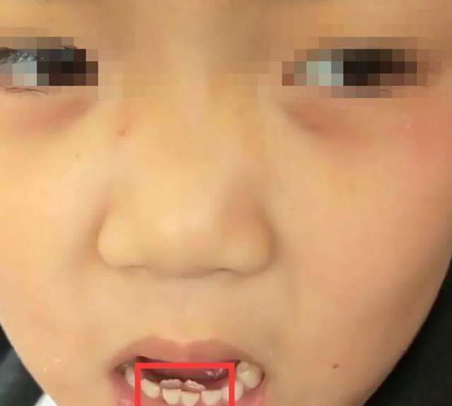 8岁男孩长出双排牙必须一颗颗拔掉妈妈的爱成了伤害
