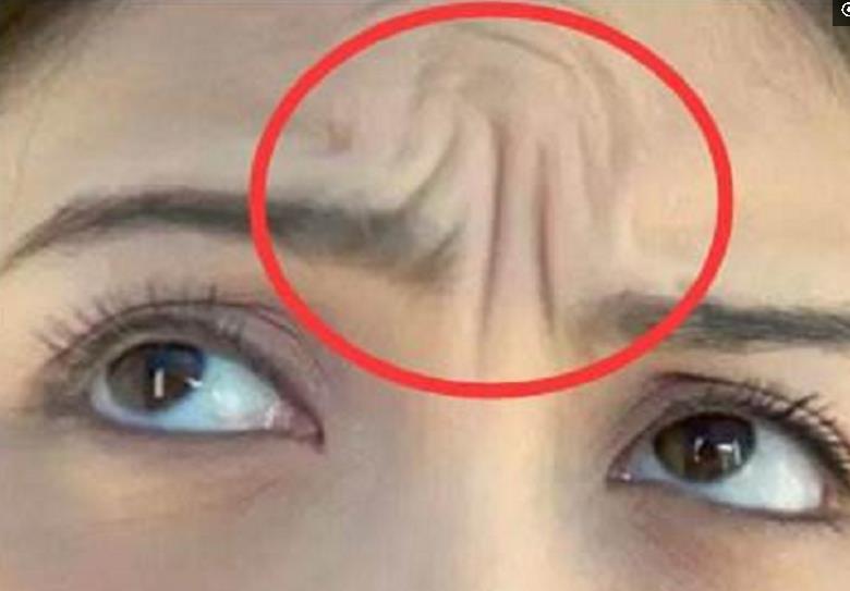 男人和女人,眉间出现"川"字纹,你了解要注意什么么?