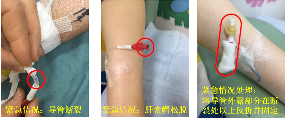 新栏目驾到!PICC导管家庭护理全解析|导管|手臂|护理_新浪新闻