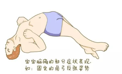 宝宝侧卧头后仰是脑瘫吗?为什么宝宝侧卧头往后仰?