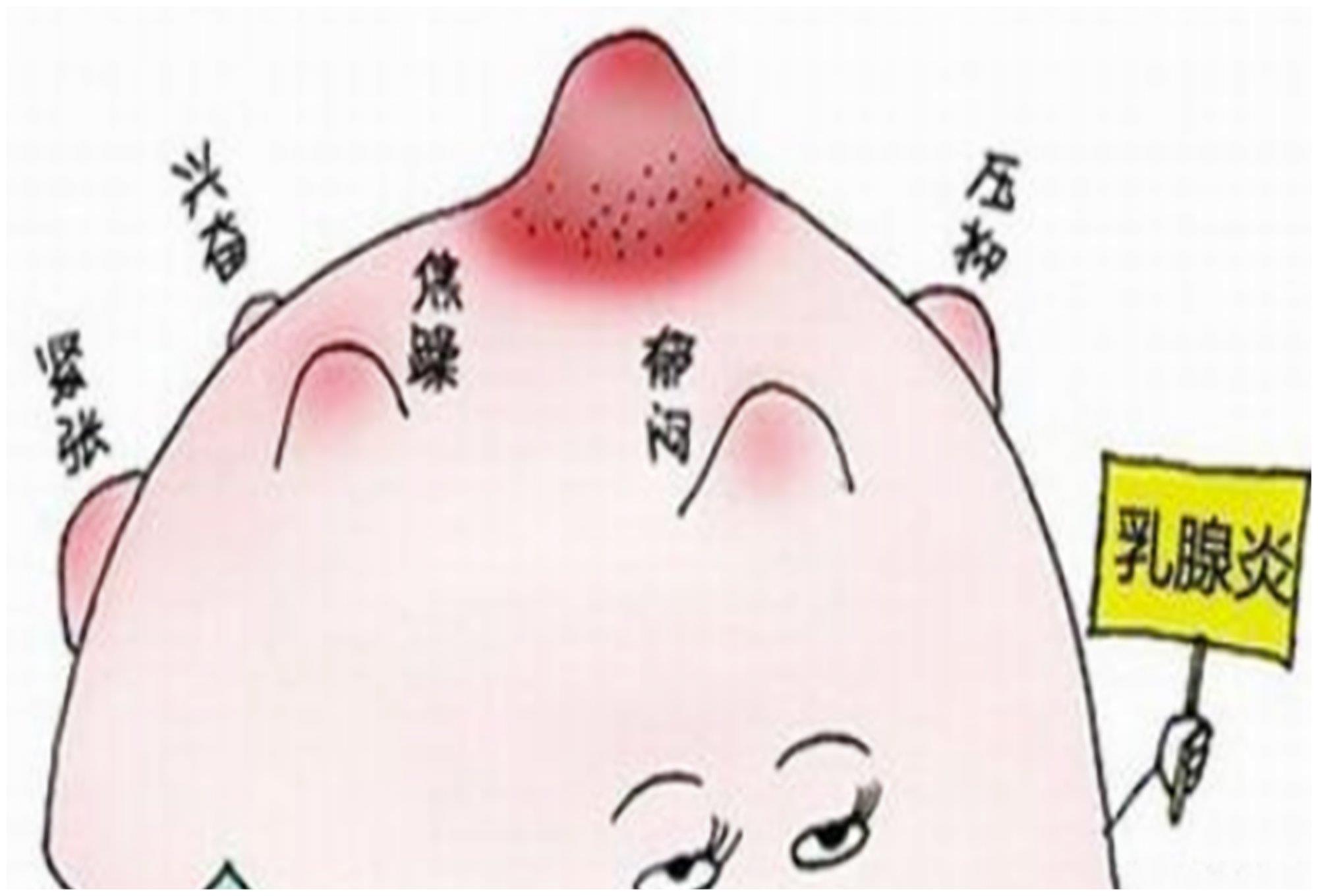 同时,发生堵奶的乳房比较脆弱,吸吮的时候很容易造成乳腺受到压迫