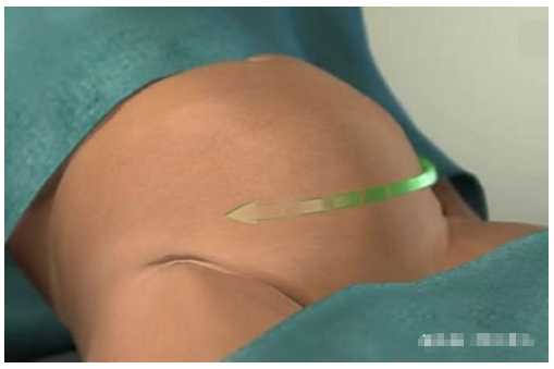 横切,顾名思义就是在产妇的肚子上横着切一刀然后将孩子取出来.