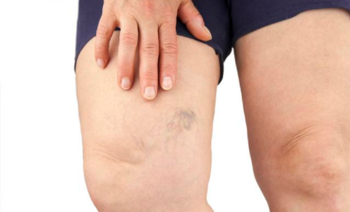 下肢出现2个表现,说明肾脏受到威胁,是尿毒症露出的马脚|尿毒症|症状