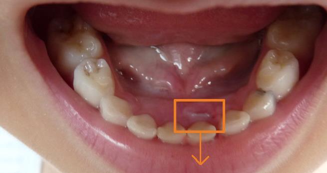 正文  前几天丽珍在给孩子刷牙的时候,发现孩子的牙齿特别奇怪,因为她