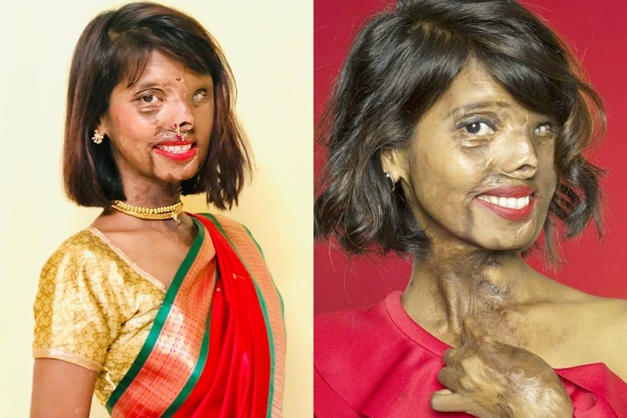 幼年被父亲泼酸整脸融化,最后活得比谁都幸福