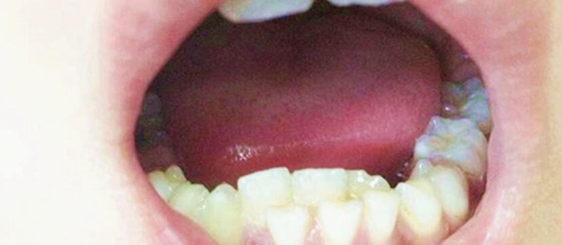 医生看了孩子的牙齿后,告诉杨女士:"这是双排牙,属于口腔疾病,一般是