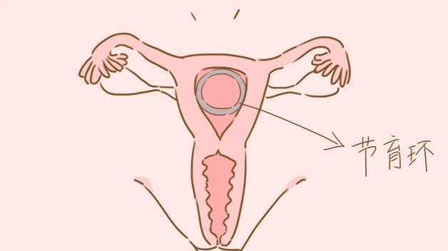 女性碰上这几种情况, 要及时取出节育环, 不然老了很受罪