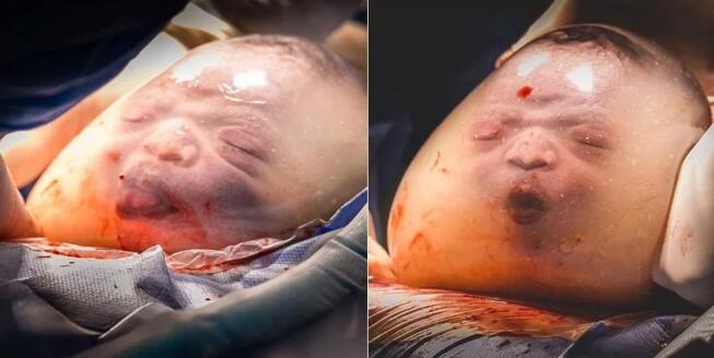 很难保证羊膜囊是完好的,宝宝包覆在样囊膜中被生下的机率是8万分之1