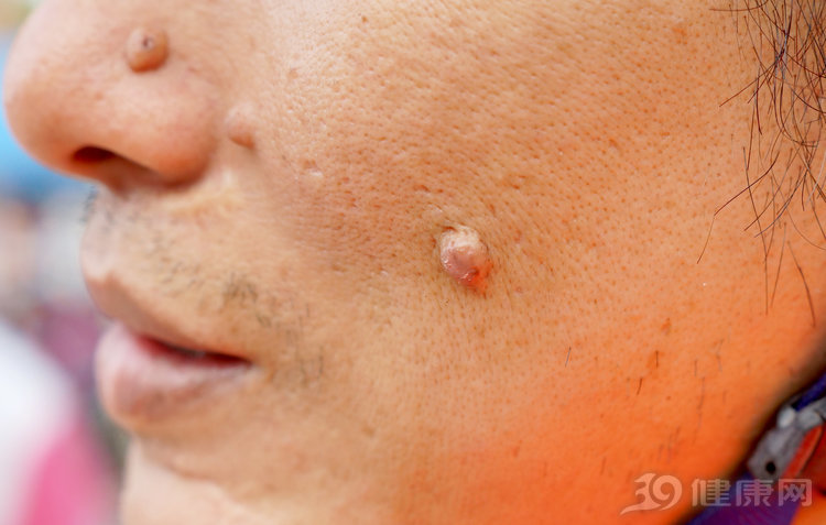 皮肤上的小肉疙瘩是什么医生给出3个解释