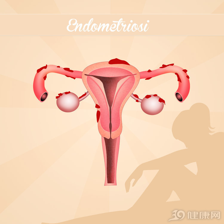 子宫肌瘤是目前比较常见的女性疾病,严重危害了女性的健康,子宫肌瘤也