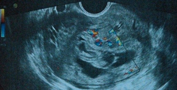 怀孕x光照片怀孕早期图片