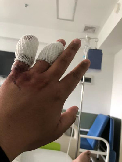 嘀嗒顺风车发生伤人事件 乘客拒绝加价被砍伤手指