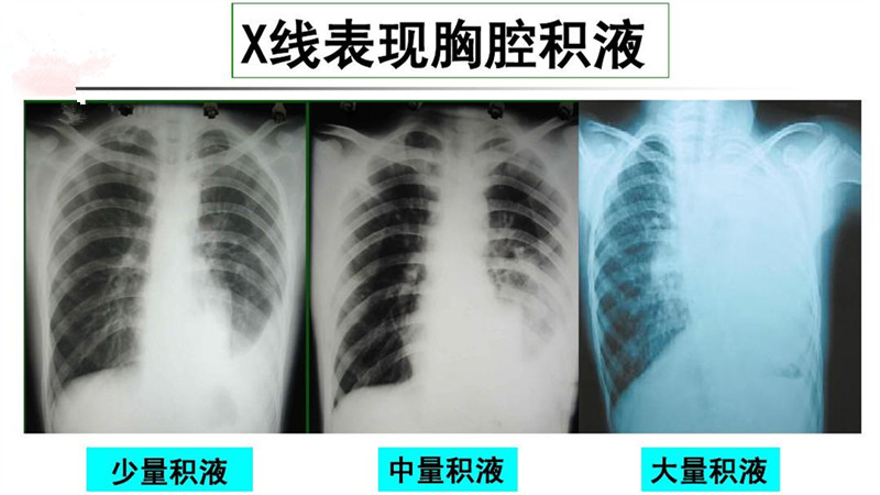 宝宝出现的胸腔积液需不需要治疗
