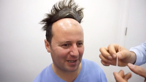 秃顶大叔因形象很苦恼,贴上假发后,看着自信满满的!