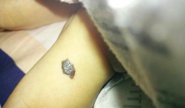 色素瘤长得快吗 20cc-hyrtarv9707370.jpg