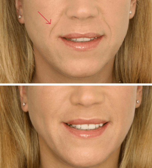 提醒大家:嘴巴旁有"八"字纹,知道这现象是什么吗?现在懂不晚