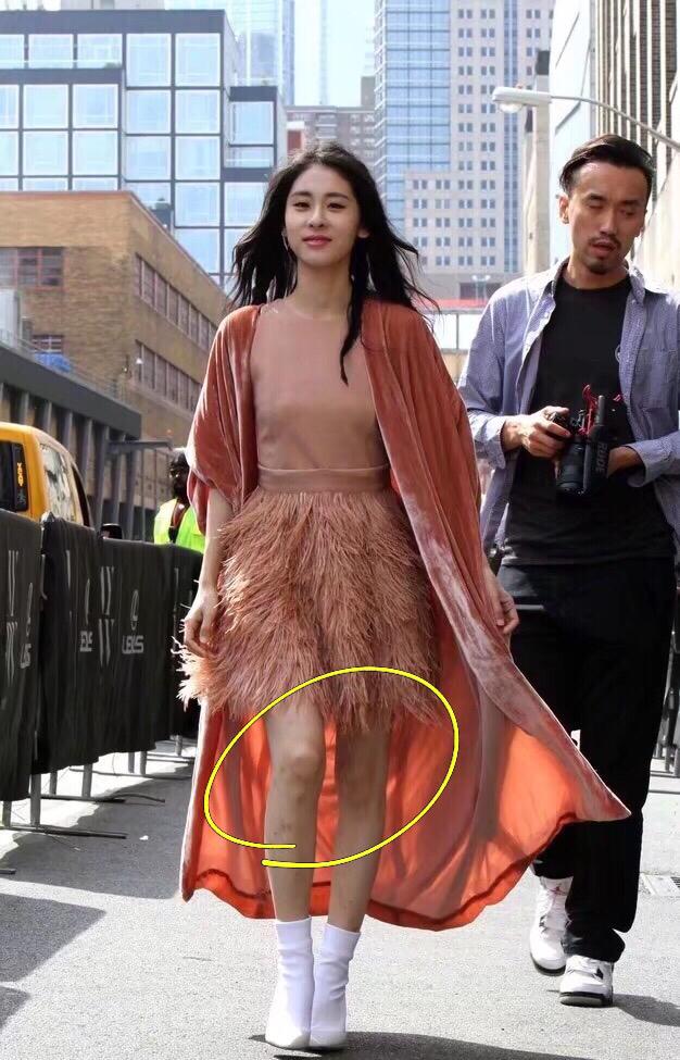继吉克隽逸的三角裤被吐槽之后,满腿都是疙瘩的张碧晨也没幸免!