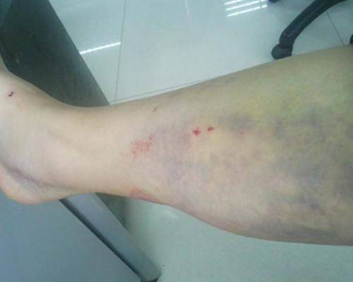 导致的,如果还出现贫血,无力头晕等症状的时候,那就是白血病的征兆了