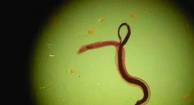 男子因为吃几只半熟螃蟹险变脑瘫|肺吸虫|脑瘫|螃蟹_新浪新闻