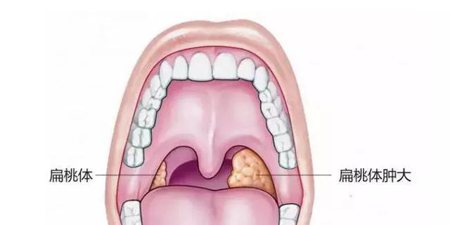 腺样体肥大保险能赔吗 腺样体手术保险报销吗
