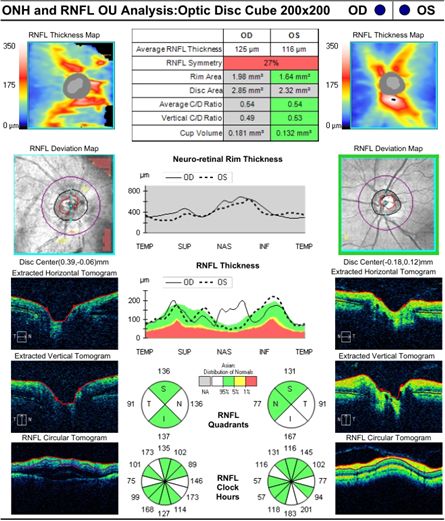 时在当地医院右眼被查出眼底出血,当时因未影响到视力就没有进行治疗