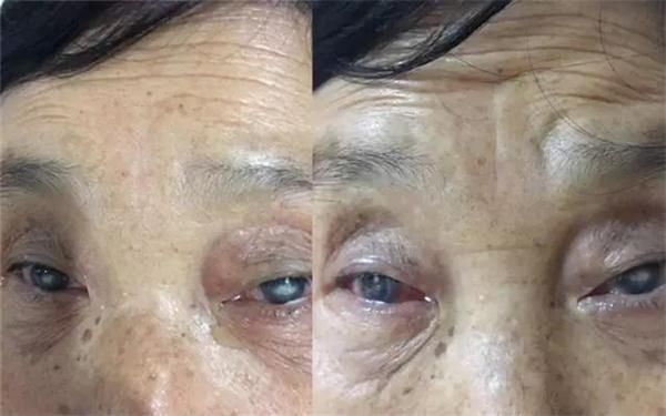 1天2人重见光明 普瑞眼科让角膜移植病人不再苦等!