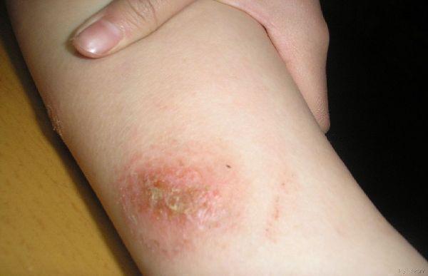 艾滋病|急性期|越南新娘_新浪网