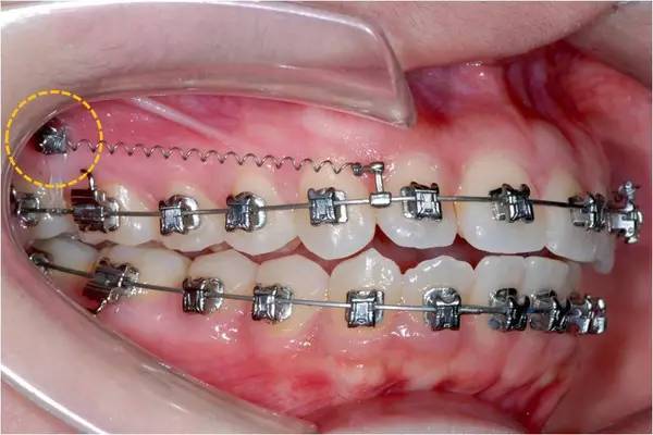 牙齿矫正需要打骨钉?别慌,这可是你牙齿变美的关键之一!