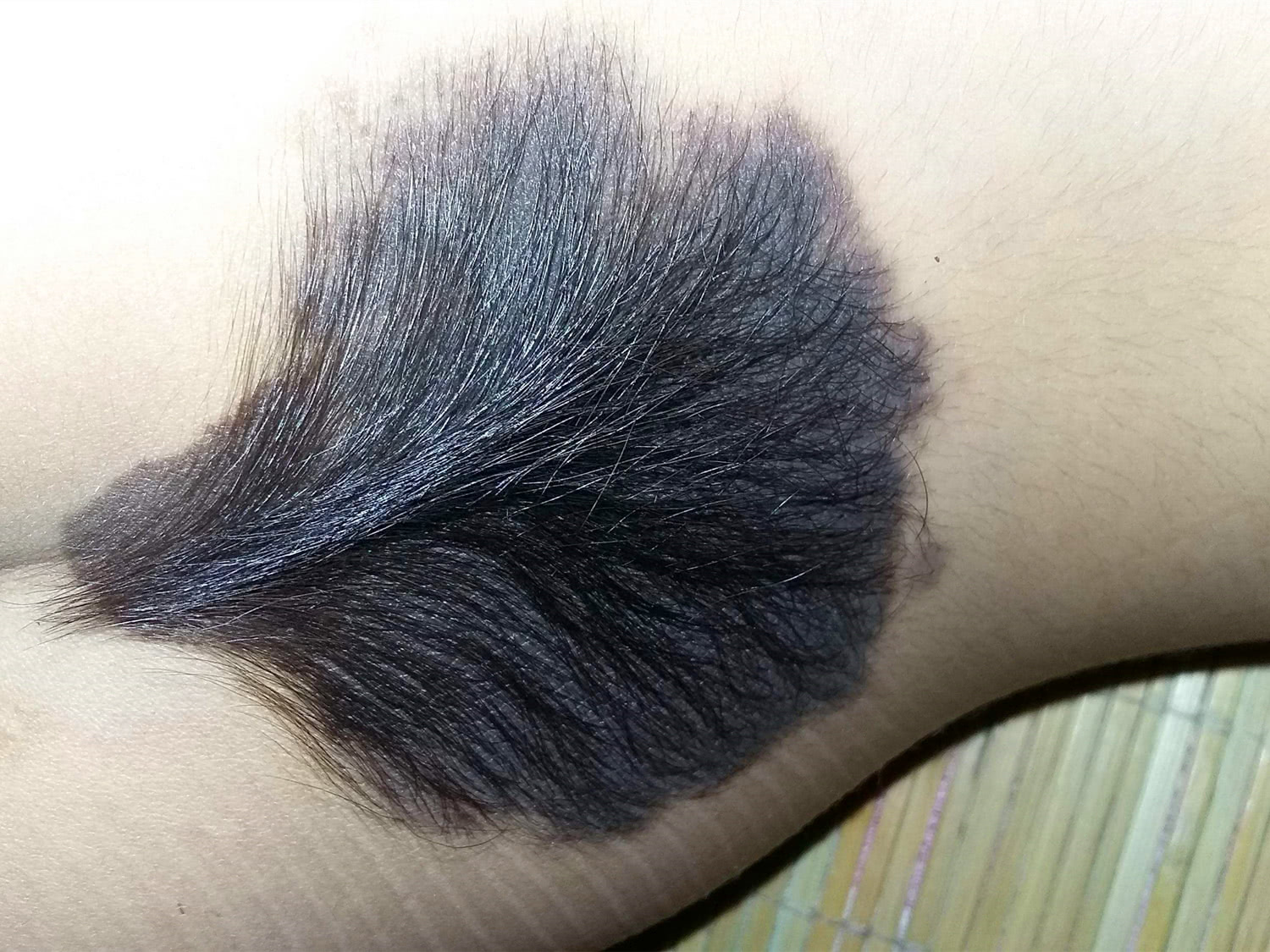 胎记种类分很多,有些可以做记号,而有些可能会致命