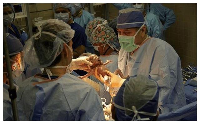 六胞胎要生医生护士紧张围一圈,还没准备好孩子就生完了!