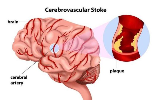4个身体异常出现,说明脑血管硬化了,3招"拯救"脑血管