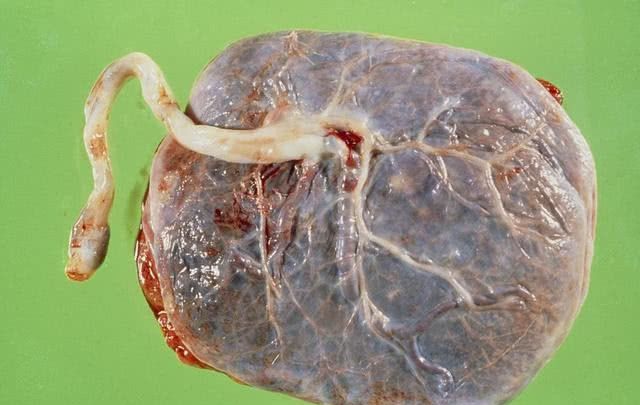 生完孩子后,胎盘是带走还是由医生处理?说出来你别不信!