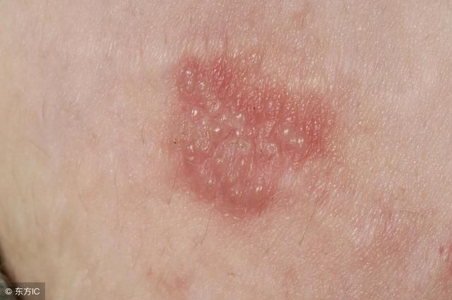 单纯疱疹你知道它的诱发因素有哪些吗