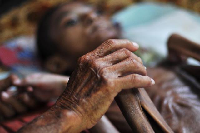 那么他的生命早已结束,因为这个孩子他得了一种怪病,身体骨瘦如柴