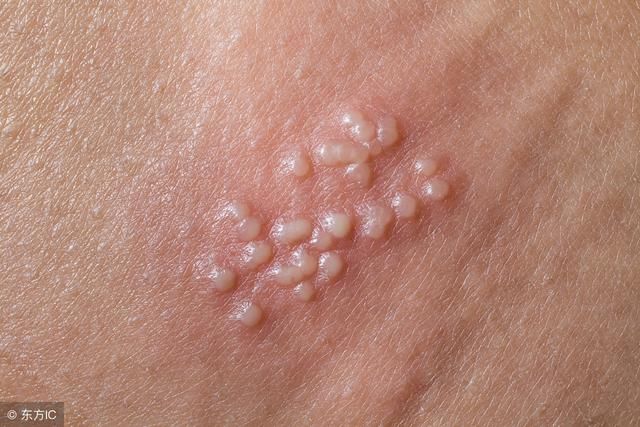 单纯疱疹|病毒|神经节_新浪新闻