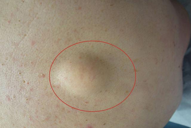 鼓包是什么意思 鼓包常见原因有哪些