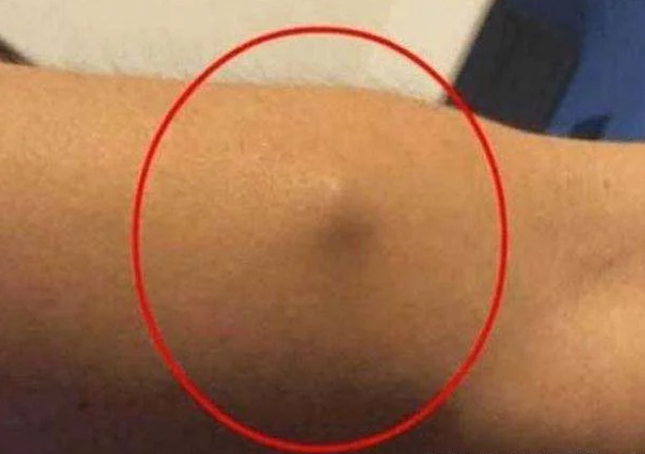 小伙胳膊上长个包去做手术,看到取出的东西,小伙不淡定了!