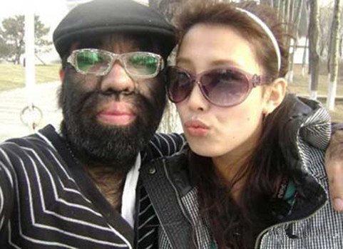 中国第一毛孩:全身是毛像猴子,曾绝望到自杀,如今成为人生赢家